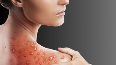 Saudi Arabia Tests Positive for Monkeypox in Nepal