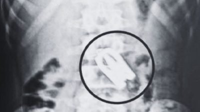 Scissors removed from 15-year-old boy’s stomach