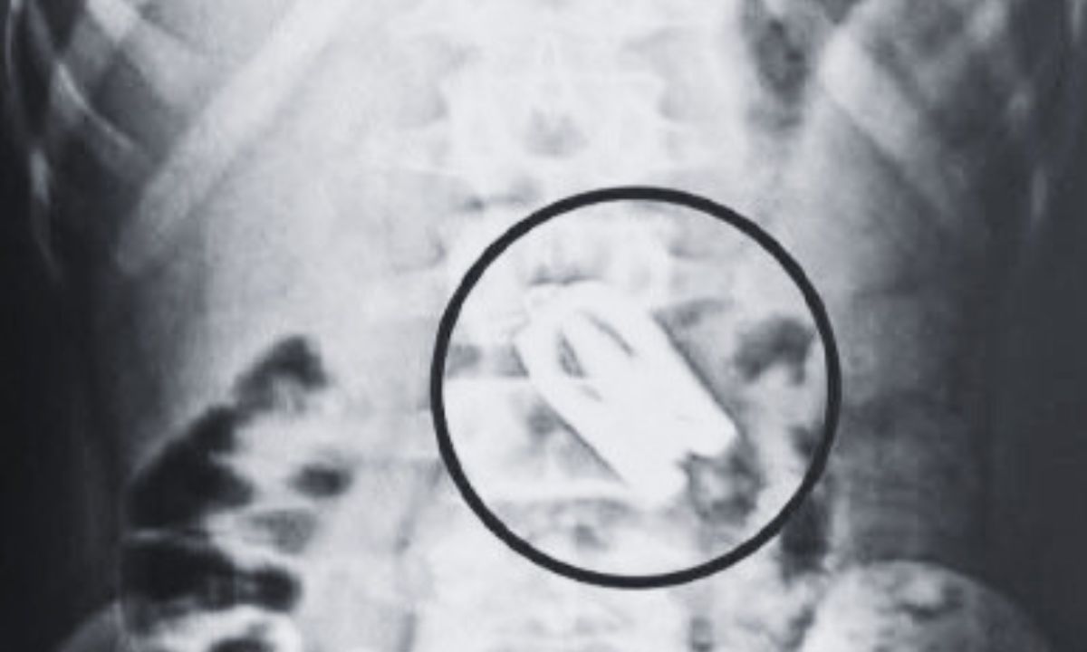 Scissors removed from 15-year-old boy’s stomach at Nobel Medical College