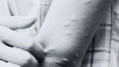 Japanese encephalitis