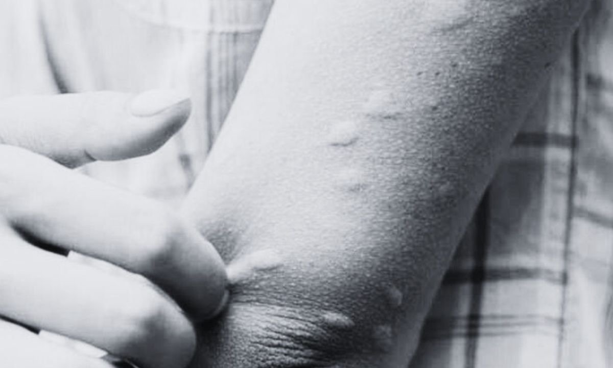 Japanese encephalitis spreads rapidly in Terai districts, 3 dead, 33 infected